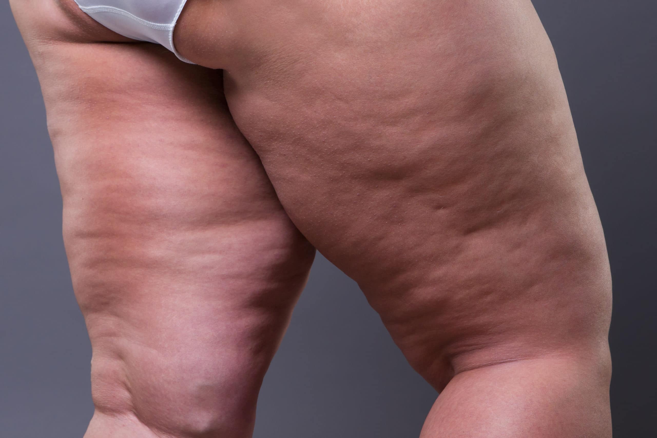 Der Alltag mit Lipödem: Tipps für Kleidung und Bewegung